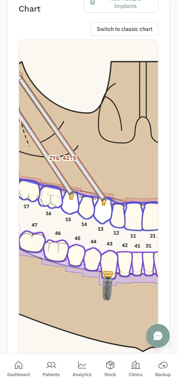FDI chart with zygomatic and conventional implants on a phone