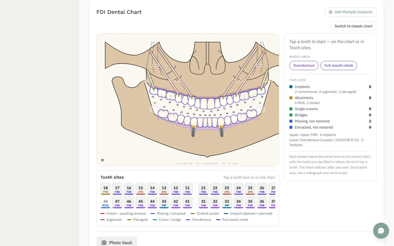 FDI chart of a full-arch case with zygomatic, pterygoid and conventional implants